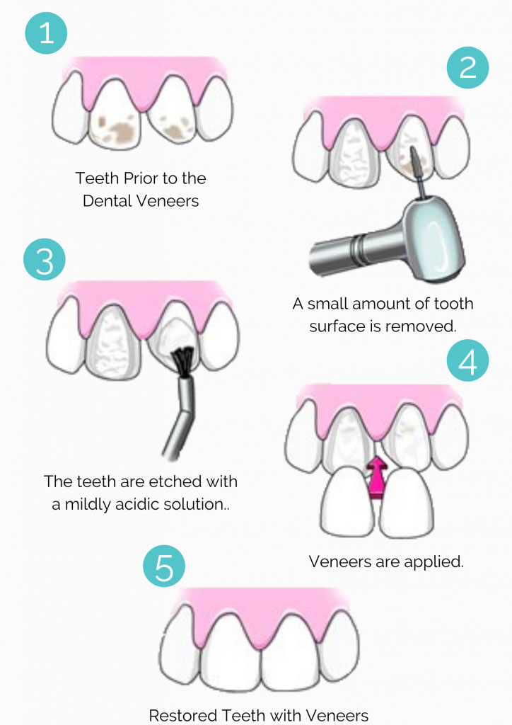 veneer-procedure veneer-procedure