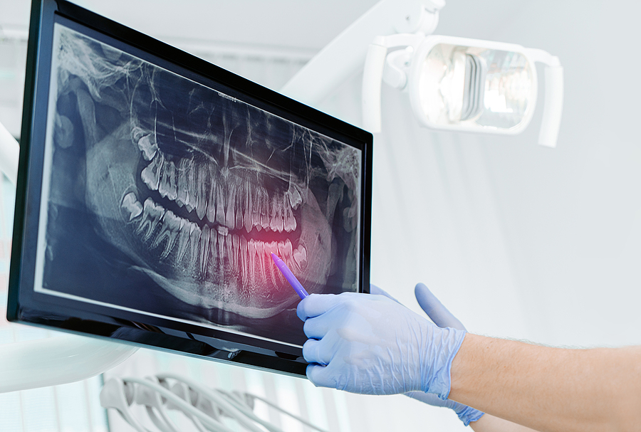 This is a thumbnail image of blog The Benefits and Importance of Digital X-Rays in Pleasanton, CA This is a thumbnail image of blog The Benefits and Importance of Digital X-Rays in Pleasanton, CA