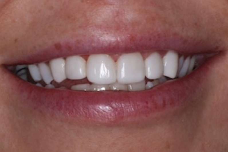 Tooth Repair With Bonding San Mateo CA