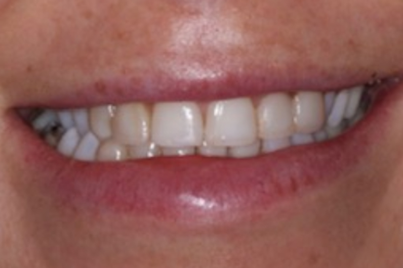 Tooth Repair With Bonding San Mateo CA